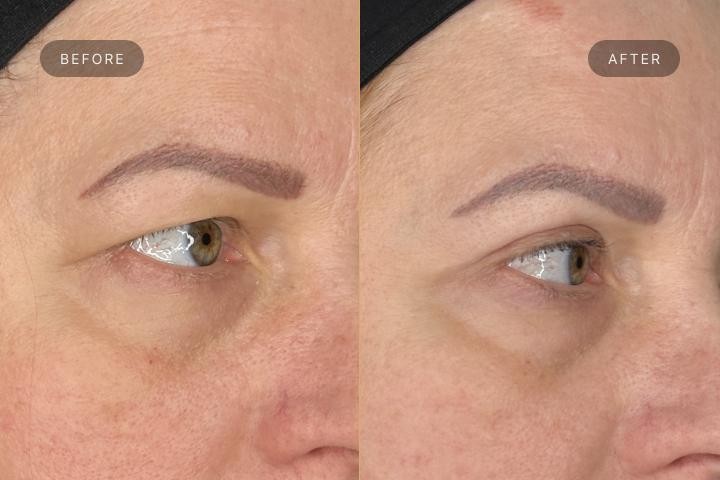 Blefaroplastie Iasi caz 1 femeie - corectie pleoape vedere semiprofil inainte si dupa