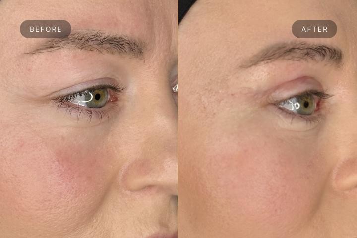 Blefaroplastie Iasi caz 2 femeie - remodelare pleoape perspectiva semiprofil inainte si dupa