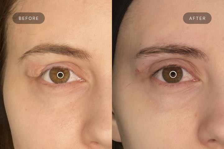 Blefaroplastie Iasi caz 3 femeie - lifting pleoape vedere din fata inainte si dupa