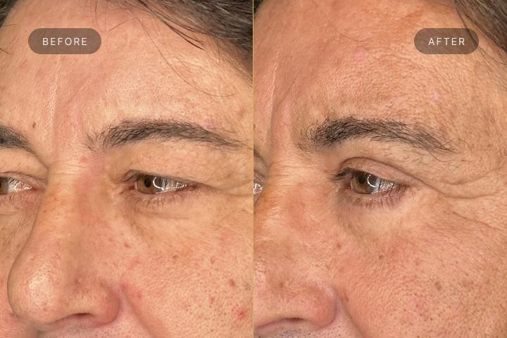 Blefaroplastie Iasi caz 4 barbat - rejuvenare pleoape vedere semiprofil inainte si dupa