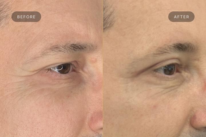 Blefaroplastie Iasi caz 5 barbat - lifting pleoape perspectiva semiprofil inainte si dupa