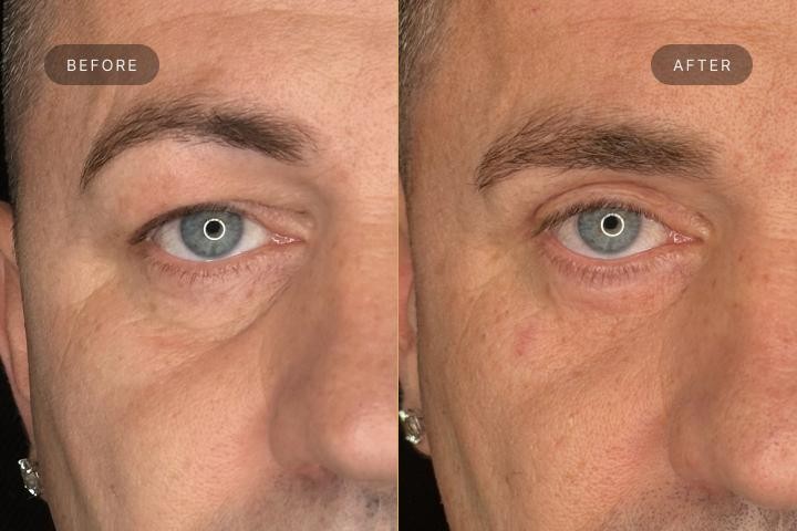 Blefaroplastie Iasi caz 6 barbat - remodelare pleoape vedere din fata inainte si dupa