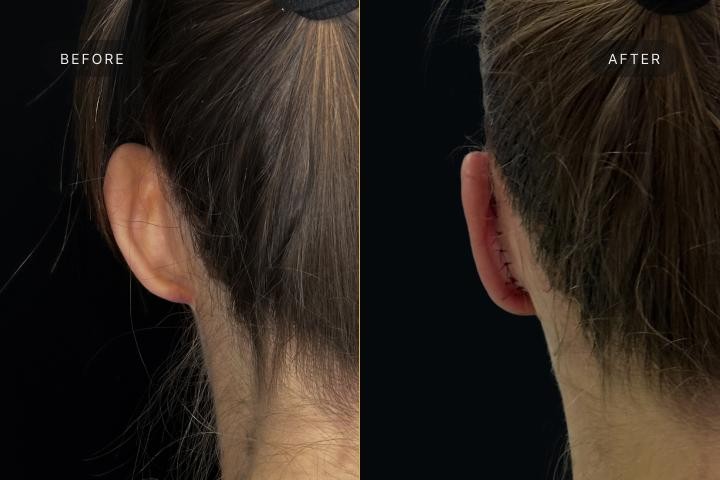 Otoplastie Iasi caz 1 femeie - corectie urechi vedere din spate inainte si dupa