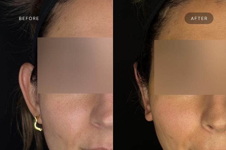 Otoplastie Iasi caz 3 femeie - remodelare urechi vedere din fata inainte si dupa
