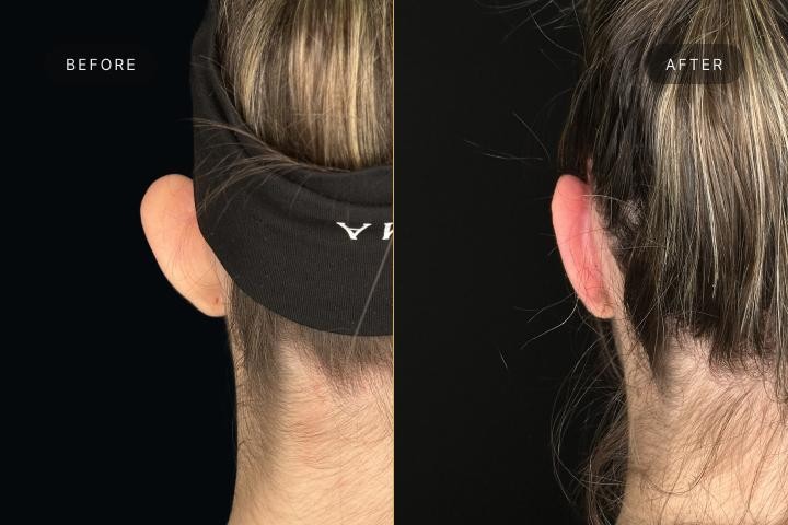 Otoplastie Iasi caz 5 femeie - remodelare urechi vedere din spate inainte si dupa