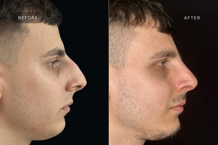 Rinoplastie Iasi caz 1 barbat - remodelare nazala vedere din profil inainte si dupa