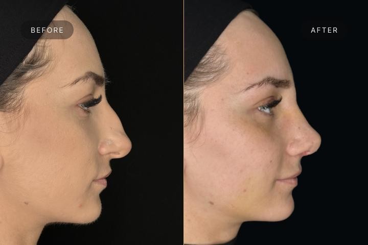 Rinoplastie Iasi caz 2 femeie - remodelare nas vedere din profil inainte si dupa