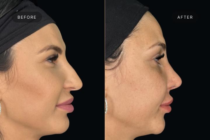 Rinoplastie Iasi caz 3 femeie - corectie forma nas vedere din profil inainte si dupa