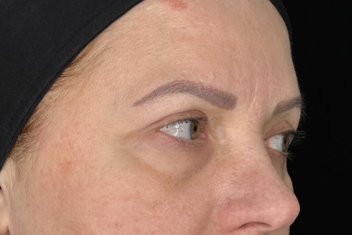 Blefaroplastie Iasi caz 1 femeie - corectie pleoape vedere semiprofil dupa