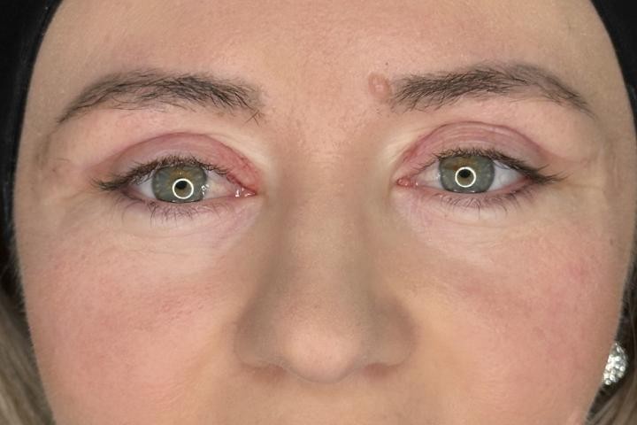Blefaroplastie Iasi caz 2 femeie - remodelare pleoape perspectiva frontala dupa