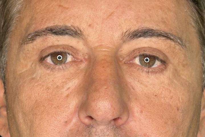 Blefaroplastie Iasi caz 4 barbat - rejuvenare pleoape vedere frontala dupa