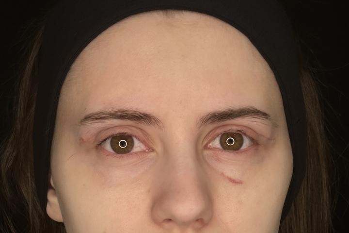 Blefaroplastie Iasi caz 3 femeie - lifting pleoape vedere din fata dupa