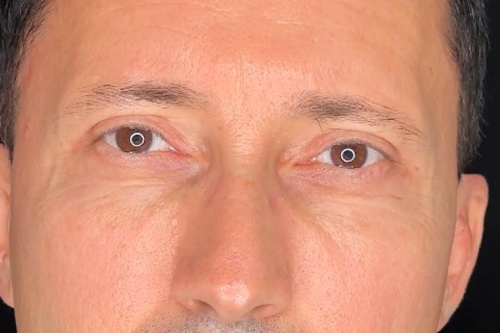 Blefaroplastie Iasi caz 5 barbat - lifting pleoape perspectiva frontala dupa