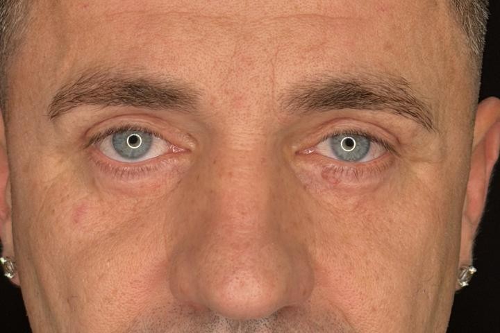 Blefaroplastie Iasi caz 6 barbat - remodelare pleoape vedere din fata dupa