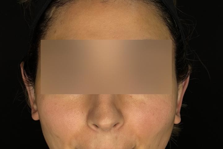 Otoplastie Iasi caz 3 femeie - remodelare urechi vedere din fata dupa