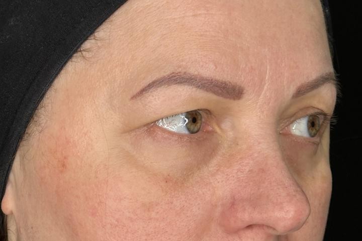 Blefaroplastie Iasi caz 1 femeie - corectie pleoape vedere semiprofil inainte