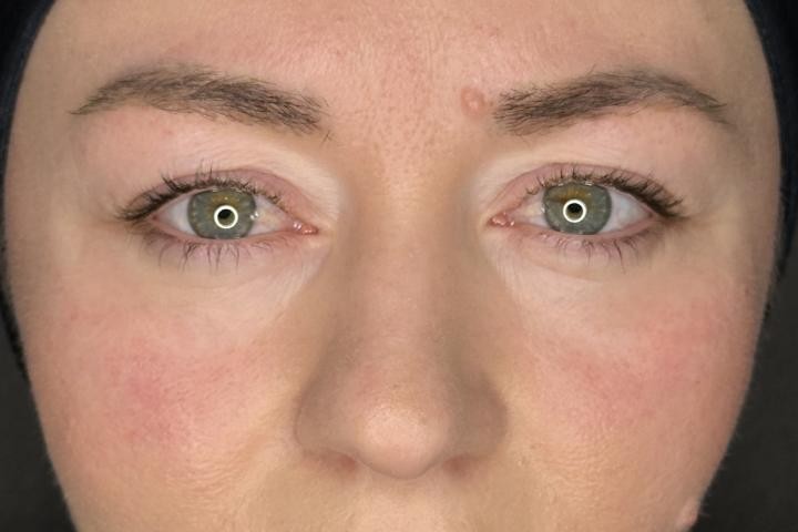 Blefaroplastie Iasi caz 2 femeie - remodelare pleoape perspectiva frontala inainte