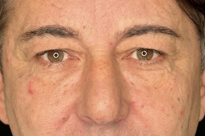 Blefaroplastie Iasi caz 4 barbat - rejuvenare pleoape vedere frontala inainte
