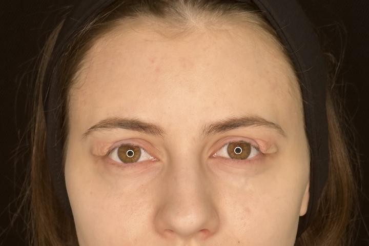 Blefaroplastie Iasi caz 3 femeie - lifting pleoape vedere din fata inainte