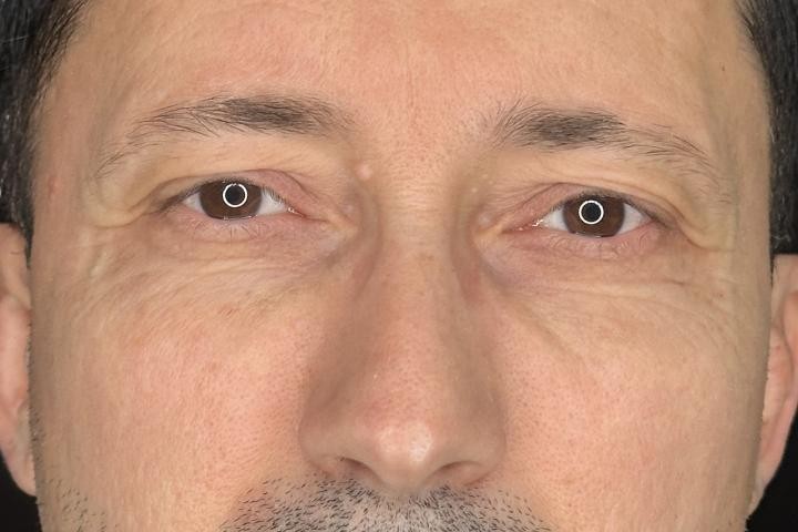 Blefaroplastie Iasi caz 5 barbat - lifting pleoape perspectiva frontala inainte