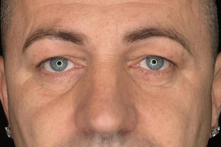 Blefaroplastie Iasi caz 6 barbat - remodelare pleoape vedere din fata inainte