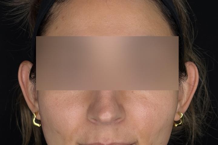 Otoplastie Iasi caz 3 femeie - remodelare urechi vedere din fata inainte
